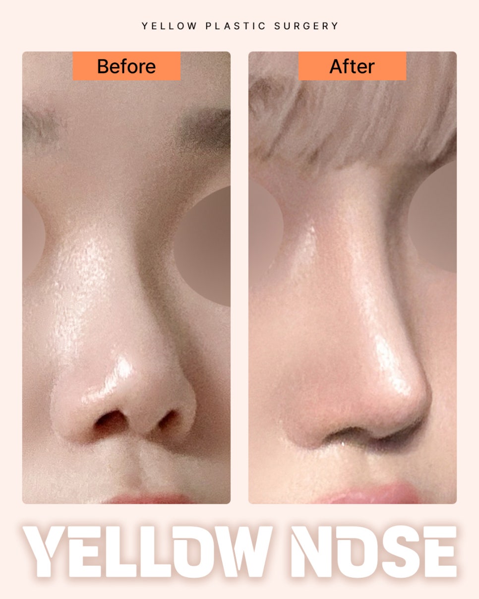 Gangnam Station Yellow Plastic Surgery / Rhinoplasty image 1