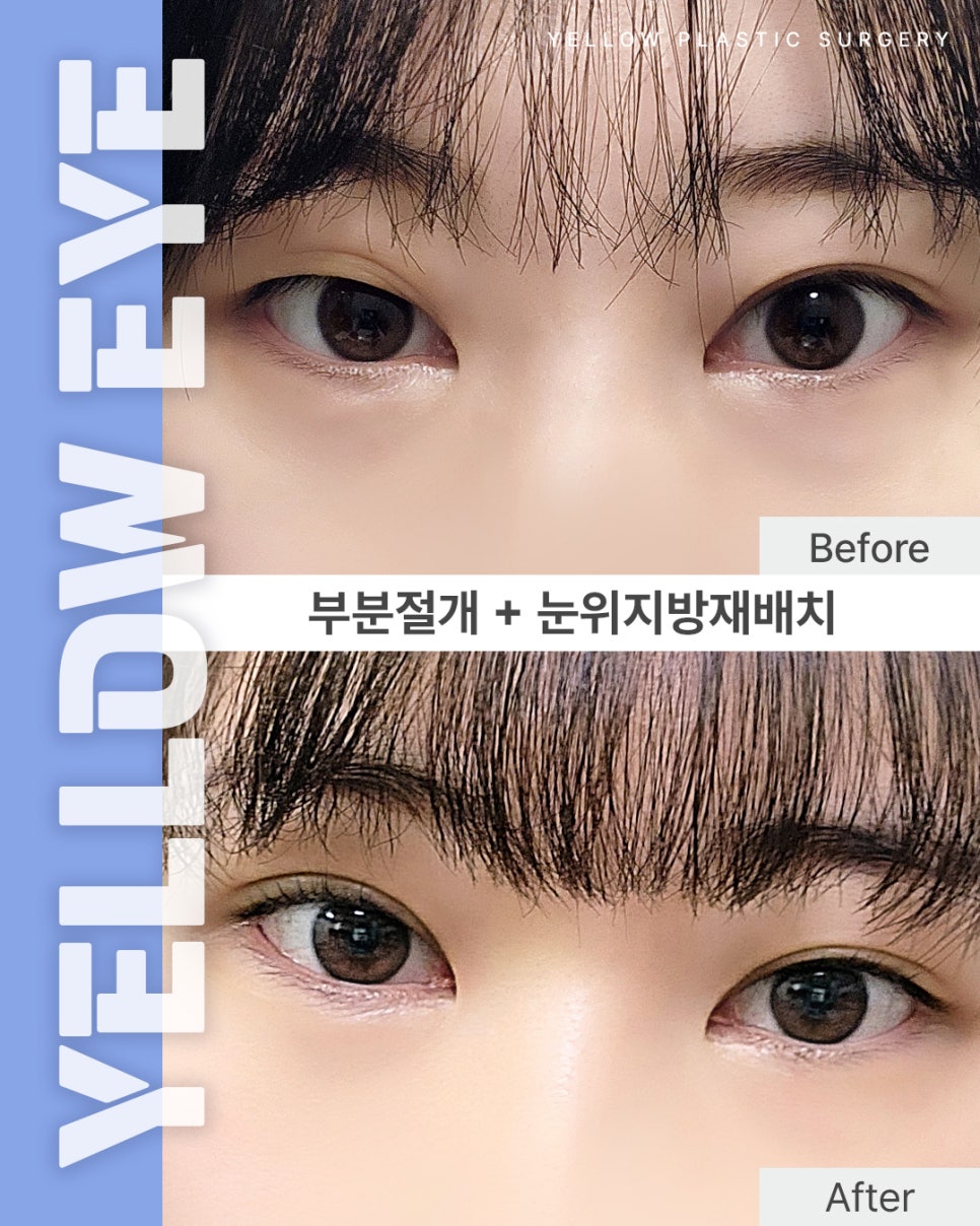 [ Gangnam Station Yellow Plastic Surgery / Eye Surgery ] Partial Incision + Upper Eyelid Fat Repositioning image 1