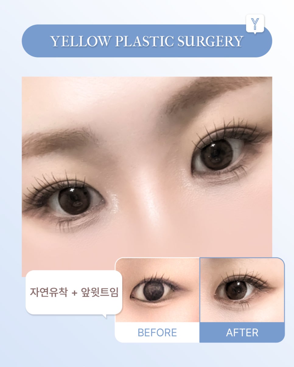 [ Gangnam Station Yellow Plastic Surgery / Eye Surgery ] Natural Adhesion + Front Upper Epicanthoplasty image 1