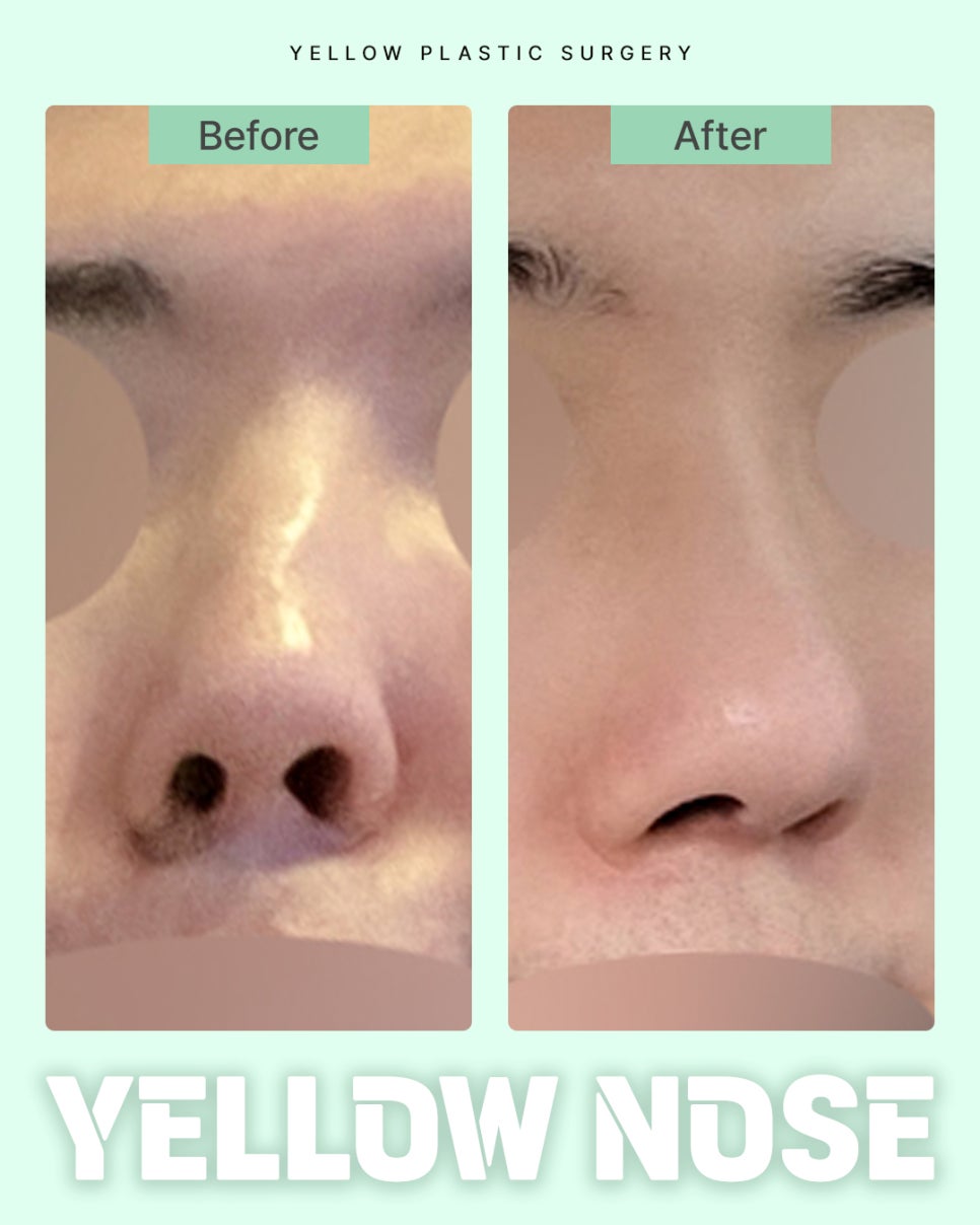 [ Gangnam Station Yellow Plastic Surgery / Rhinoplasty ] image 1