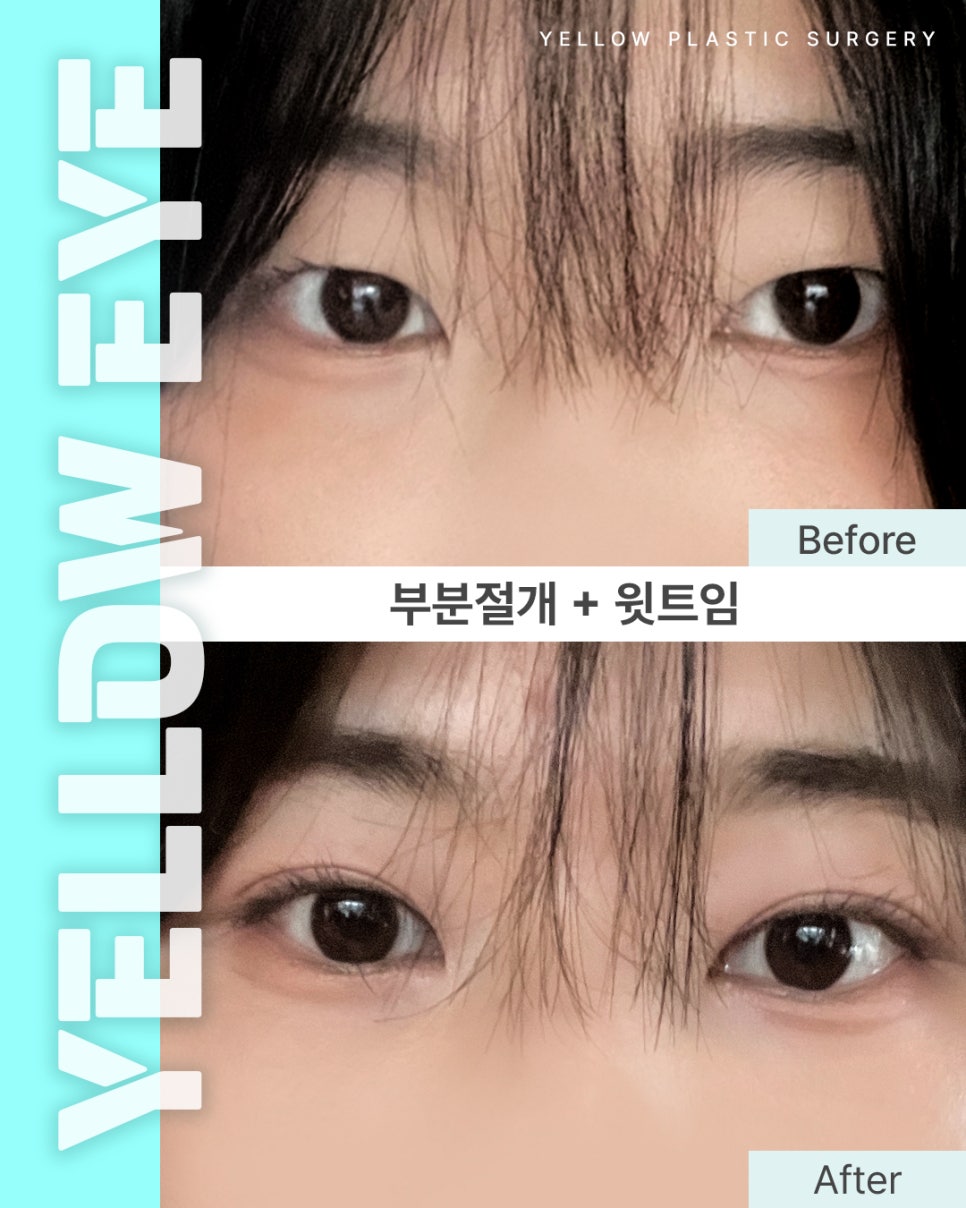 [ 강남역 옐로우성형외과 / 눈성형 ] 부분절개 + 윗트임 관련 이미지 1