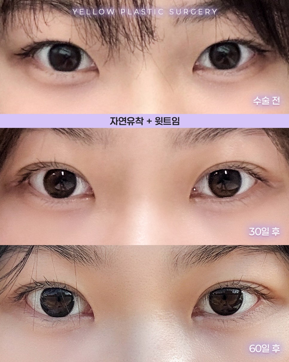 [ 강남역 옐로우성형외과 / 눈성형 ] 자연유착 + 윗트임 관련 이미지 1