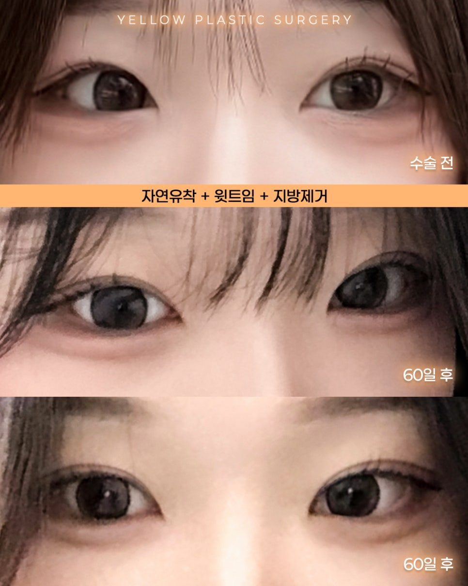 [ 강남역 옐로우성형외과 / 눈성형 ] 자연유착 + 윗트임 + 지방제거 관련 이미지 1