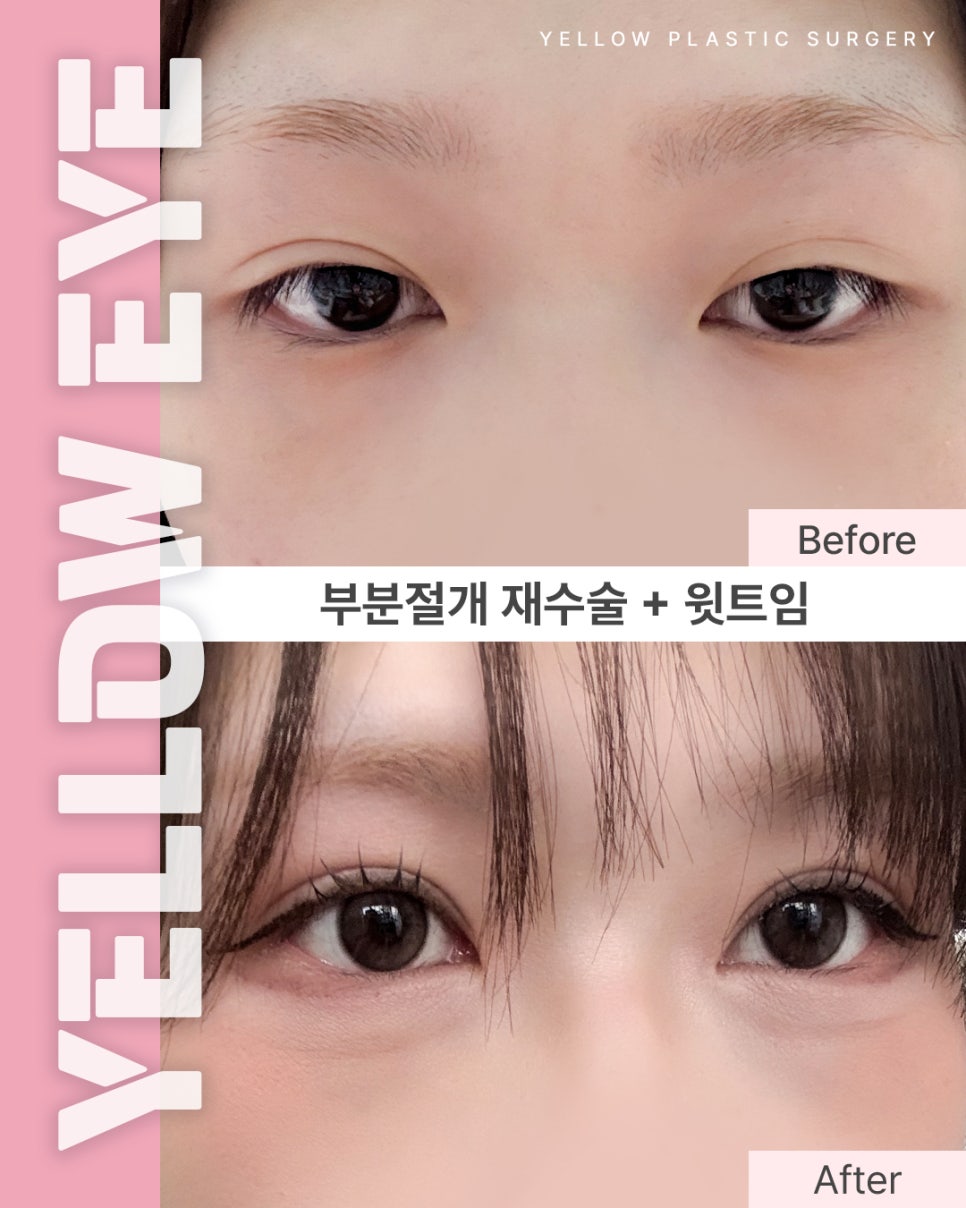[ 강남역 옐로우성형외과 / 눈성형 ] 부분절개 재수술 + 윗트임 관련 이미지 1