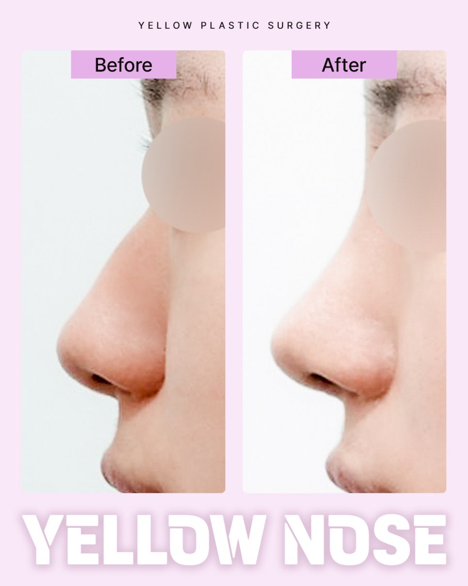 Gangnam Station Yellow Plastic Surgery / Rhinoplasty image 1