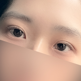 [ 강남역 옐로우성형외과 / 눈성형 ]  자연유착 눈수술 쌍수 후기 관련 이미지 4