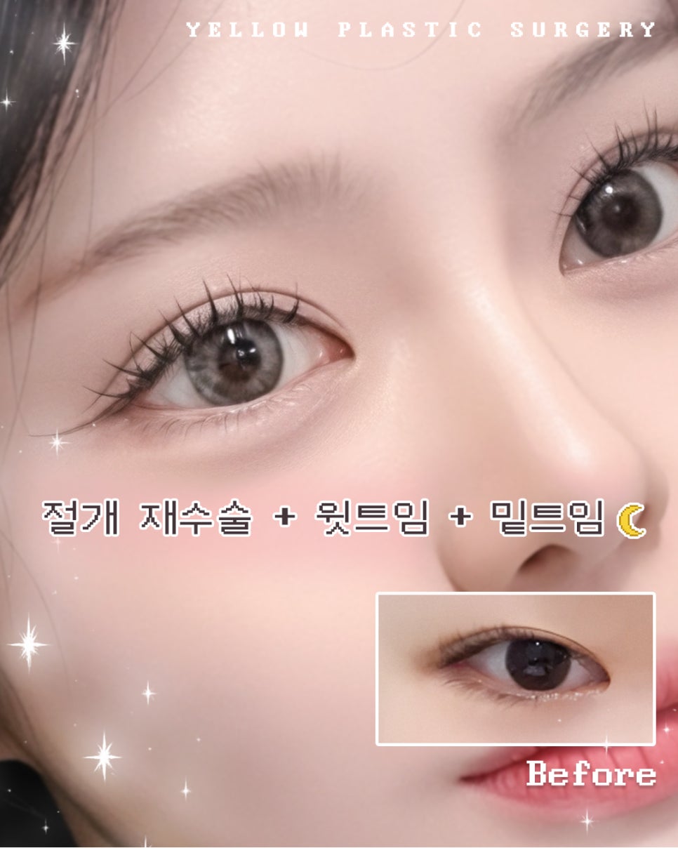 [ 강남역 옐로우성형외과 / 눈성형 ] 절개 재수술 + 윗트임 + 밑트임 관련 이미지 1