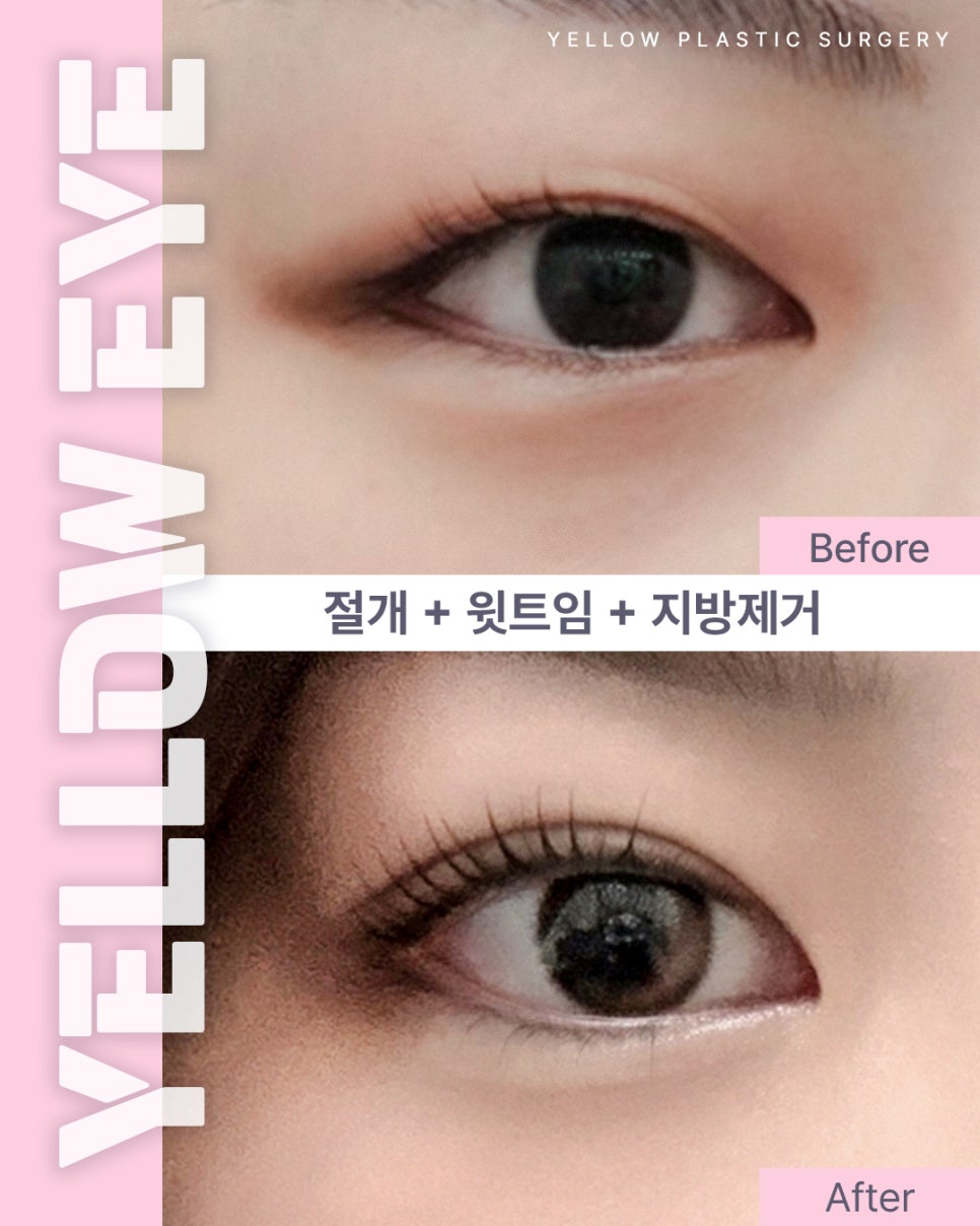 [Gangnam Station Yellow Plastic Surgery / Eye Surgery] Incision + Upper Canthoplasty + Fat Removal image 1