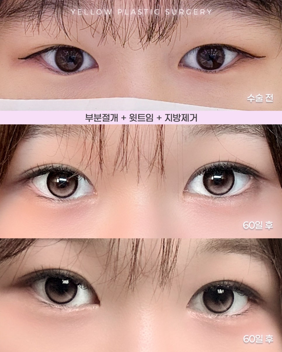 [ 강남역 옐로우성형외과 / 눈성형 ] 부분절개 + 윗트임 + 지방제거 관련 이미지 1