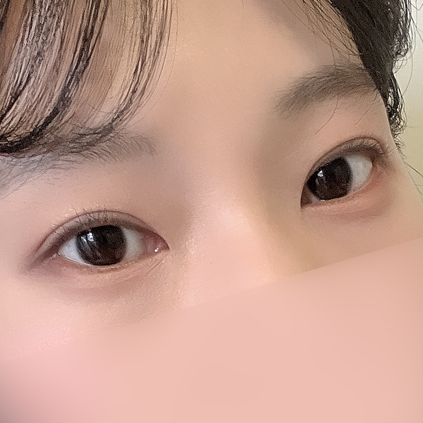[ 강남역 옐로우성형외과 / 눈성형 ] 부분절개 재수술 후기 관련 이미지 6