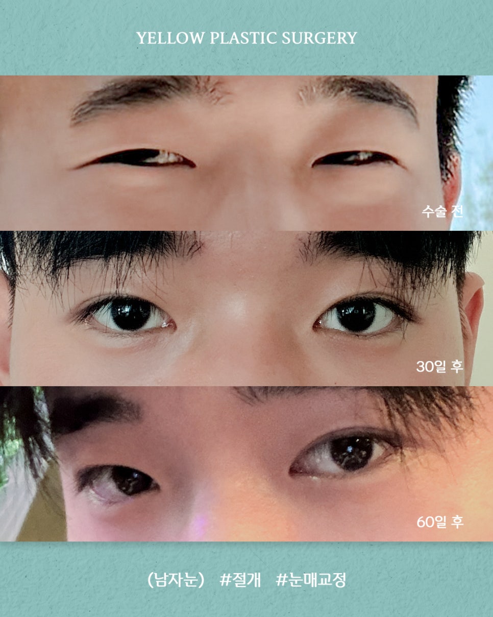 [ 강남역 옐로우성형외과 / 눈성형 ] (남자눈) 절개 + 눈매교정 관련 이미지 1