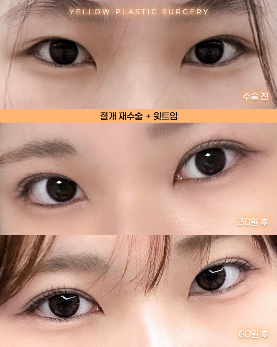 [ Gangnam Station Yellow Plastic Surgery / Eye Surgery ] Revision Incisional Surgery + Upper Canthoplasty image 1