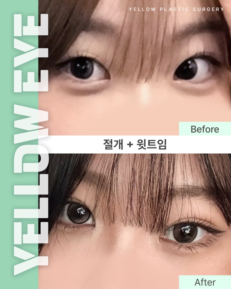 [ 강남역 옐로우성형외과 / 눈성형 ] 절개 + 윗트임 관련 이미지 1