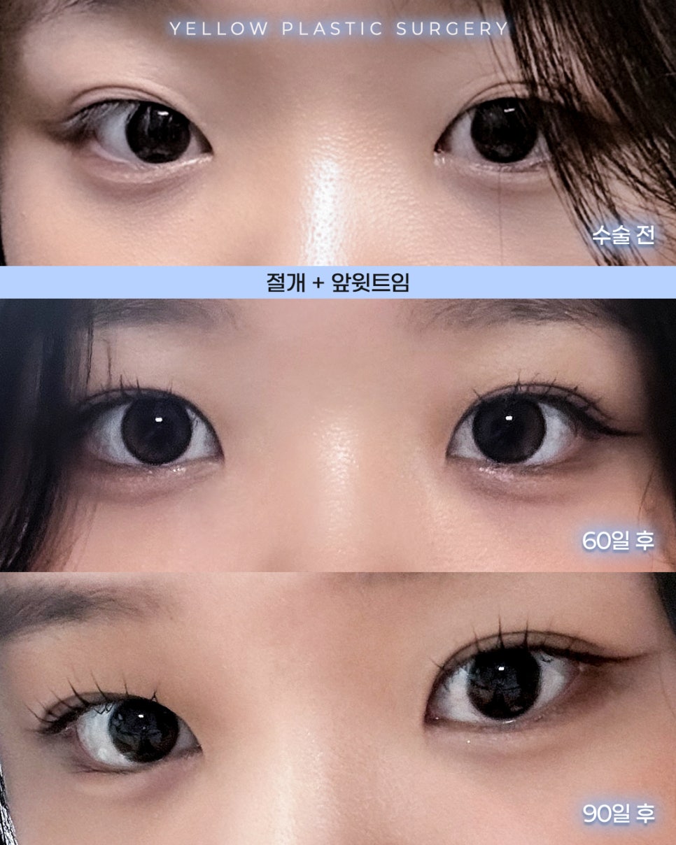 [ Gangnam Station Yellow Plastic Surgery / Eye Plastic Surgery ] Incision + Inner Upper Epicanthoplasty image 1