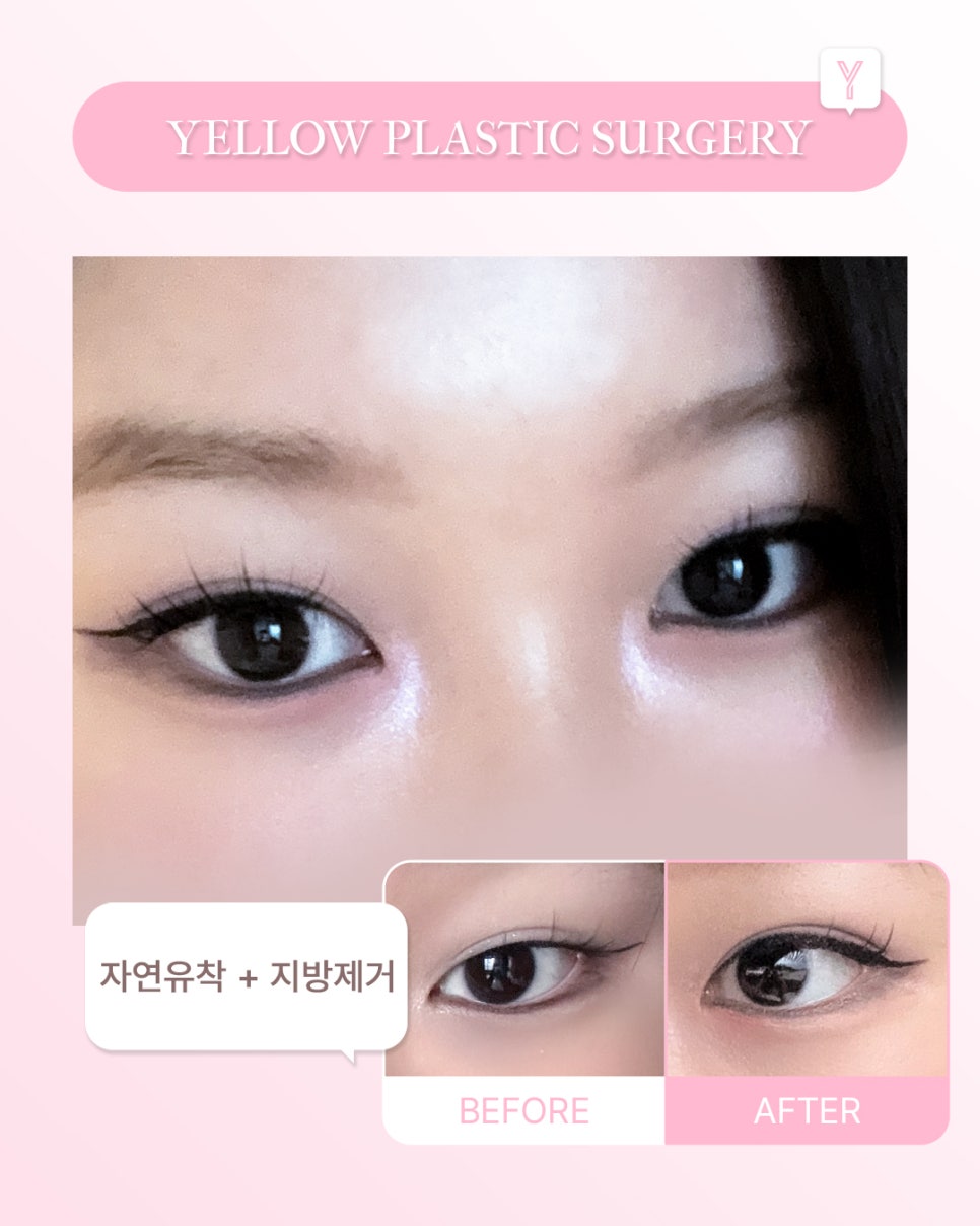 [ Gangnam Station Yellow Plastic Surgery Clinic / Eye Surgery ] Natural Adhesion + Fat Removal image 1