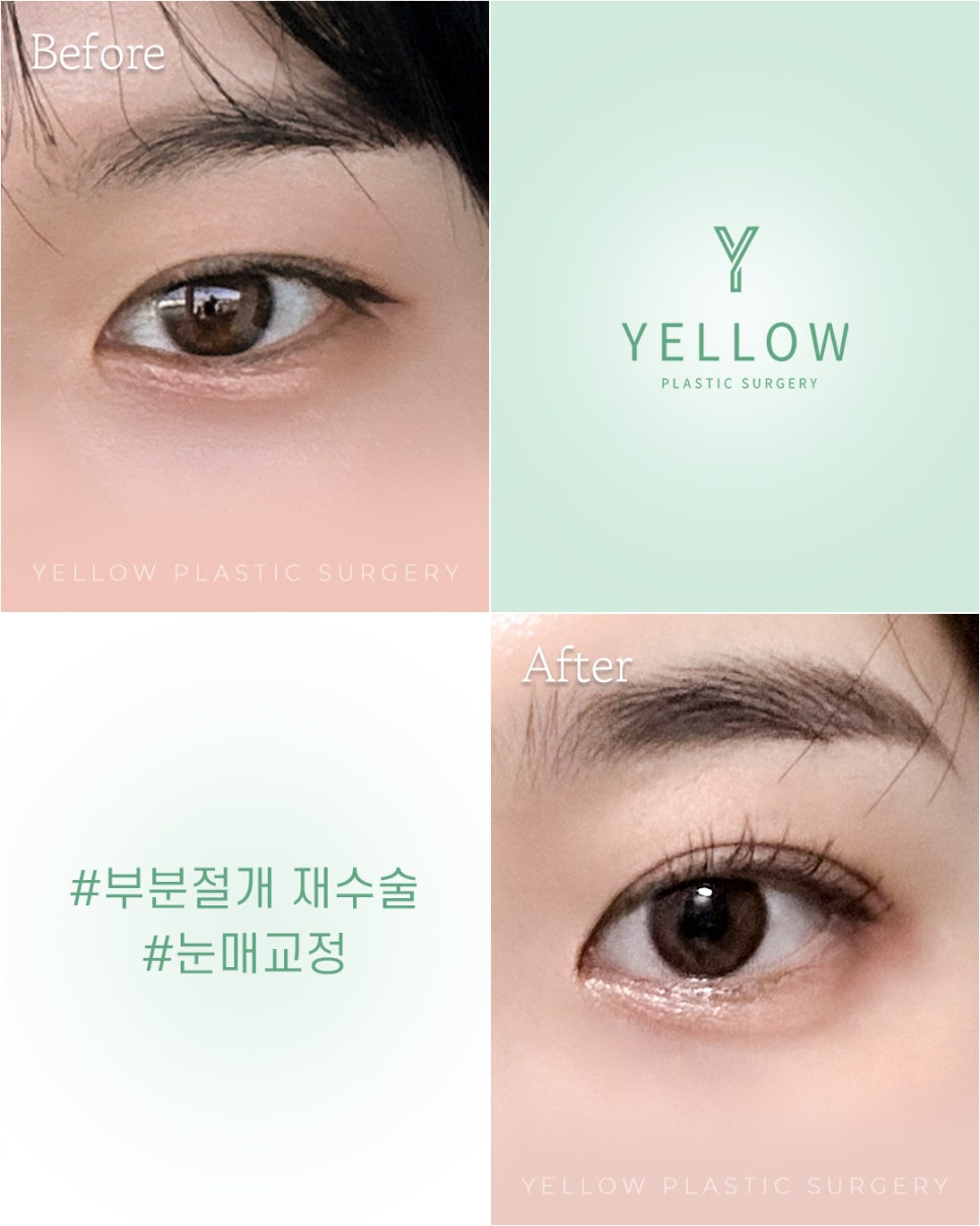 [ 강남역 옐로우성형외과 / 눈성형 ] 부분절개 재수술 + 눈매교정 관련 이미지 1