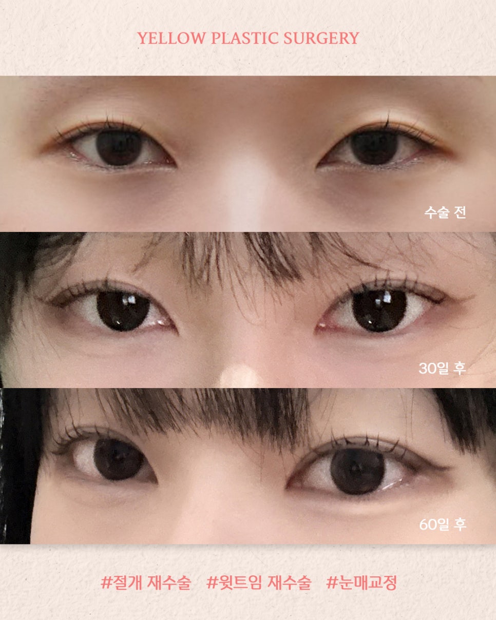[ 강남역 옐로우성형외과 / 눈성형 ] 절개 재수술 + 윗트임 재수술 +눈매교정 관련 이미지 1