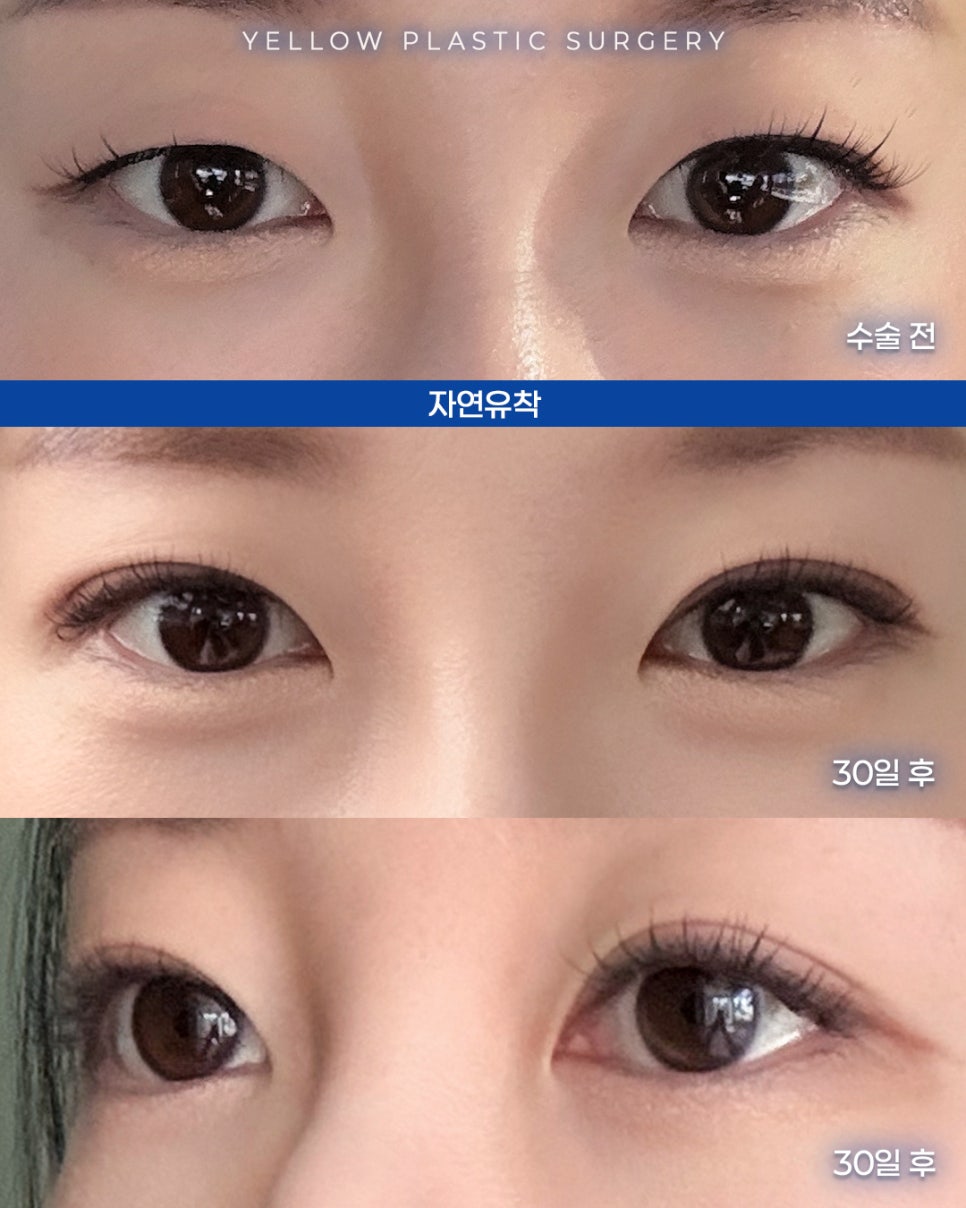 [ Gangnam Station Yellow Plastic Surgery / Eye Surgery ] Natural Adhesion image 1