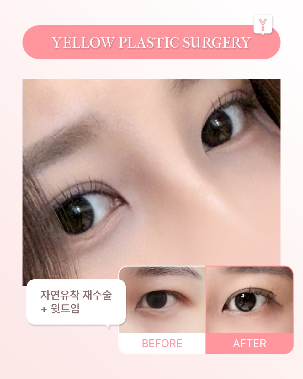 [ Gangnam Station Yellow Plastic Surgery / Eye Surgery ] Natural Adhesion Revision Surgery + Upper Eye Opening image 1
