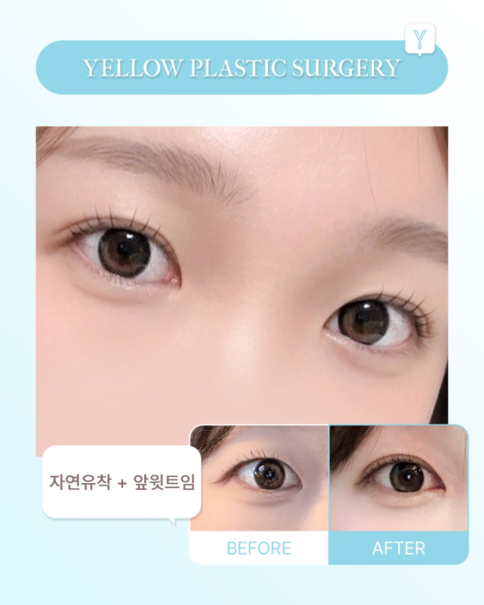 [ 강남역 옐로우성형외과 / 눈성형 ] 자연유착 + 앞윗트임 관련 이미지 1