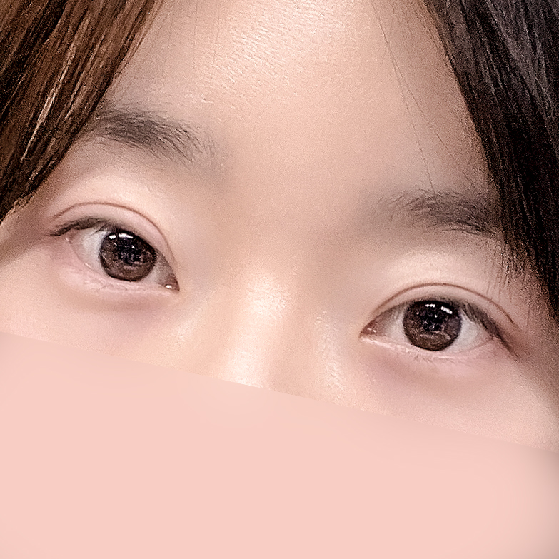 [Gangnam Station Yellow Plastic Surgery / Eye Surgery] Seven-Month Review After First Partial Incision Surgery: Improvement in Uneven Eyes image 12