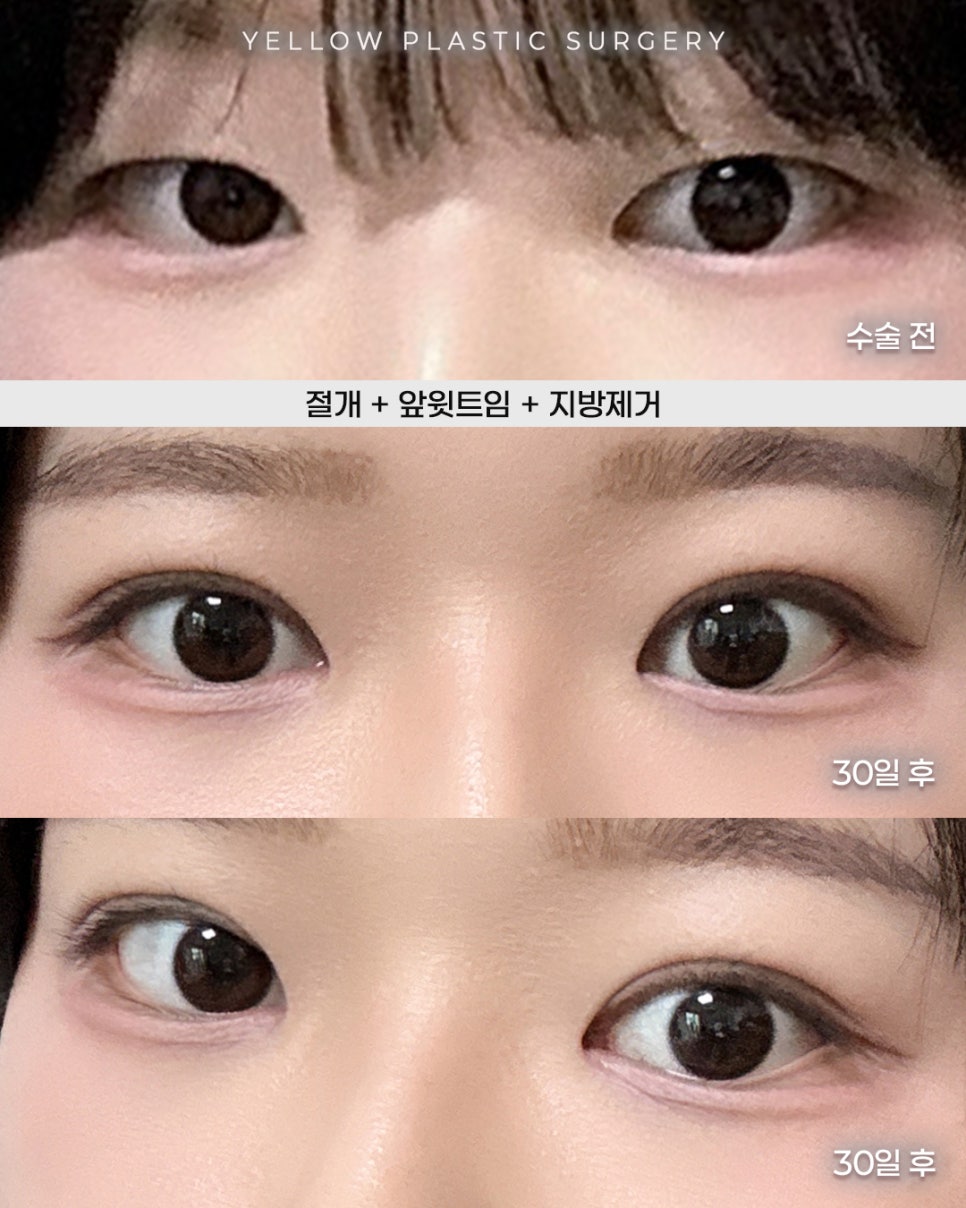 [ Gangnam Station Yellow Plastic Surgery / Eye Surgery ] Incision + Inner Upper Epicanthoplasty + Fat Removal image 1