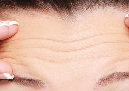 Forehead Wrinkle Removal - Restylane Forehead Filler, Han Go-eun Model Selection image 1