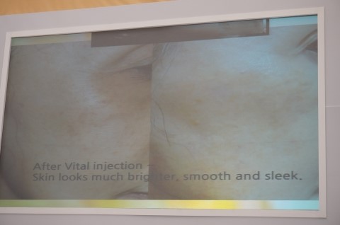 I Went to the Restylane 20 Million Treatment Commemoration Beauty Week image 29