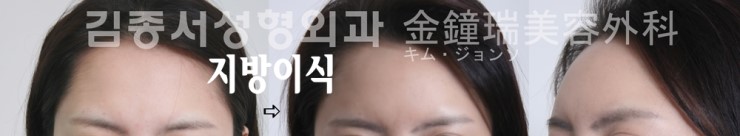 이마 성형 2002년부터 연구발표, 수많은 신문 기사에 ..김종서성형외과/ 봉긋한 이마 /동안이마 관련 이미지 6