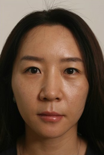 V라인 얼굴라인 실리프팅 (브이락리프팅,실루엣,성형,주름,실리프팅) 관련 이미지 5