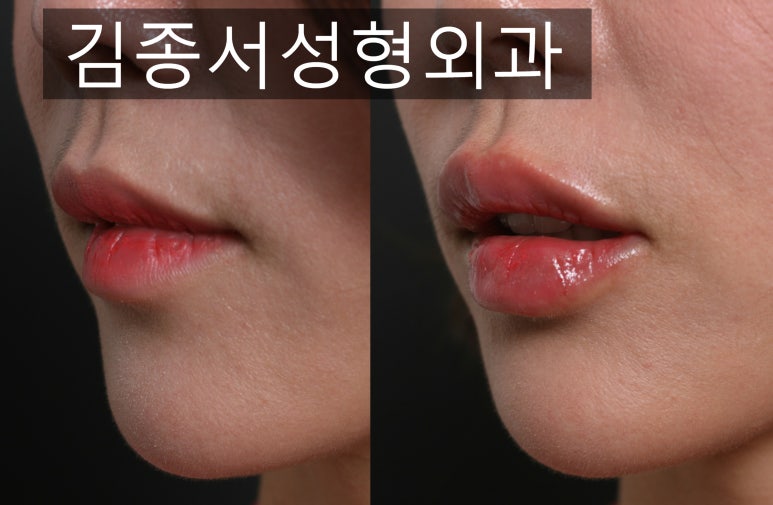 “Naturally Voluminous Lips” Recommended Lip Filler at Kim Jong-seo Plastic Surgery image 1