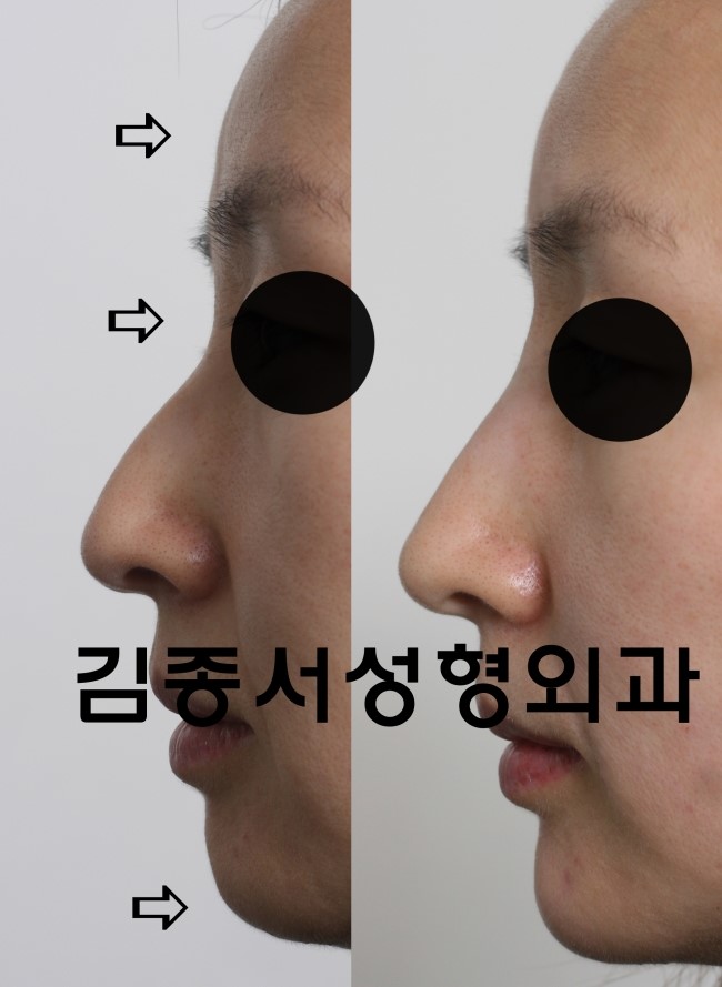 엘란쎄 강의/2013 대한미용성형외과 학회/ 코엑스 2013.4.27일 관련 이미지 8