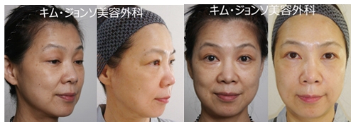 강남이마주름 - 이마주름 제거 성형외과 관련 이미지 1