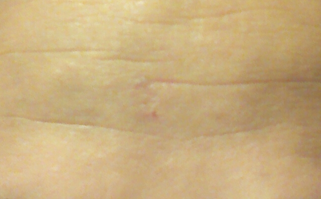 Forehead Wrinkle Removal - Restylane Forehead Filler, Han Go-eun Model Selection image 5