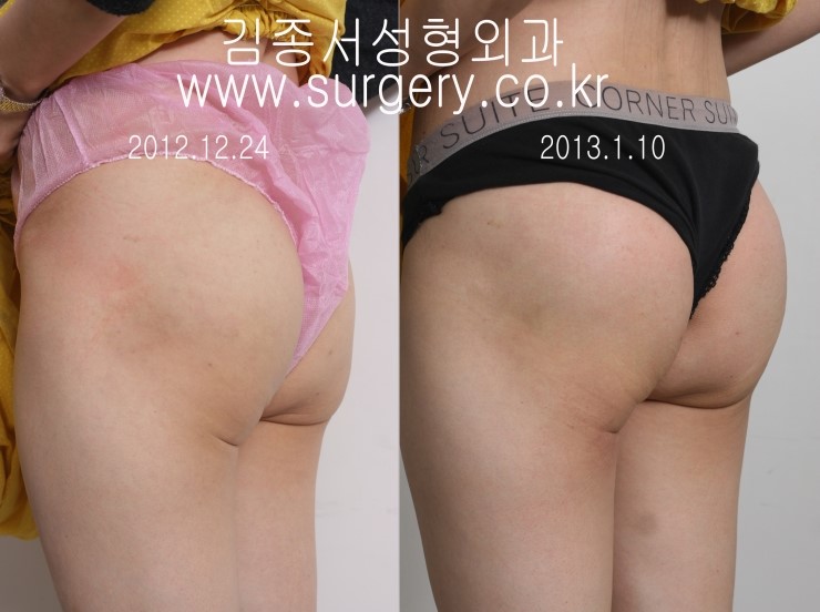 [리프팅] 힙업리프팅 / 힙업실리프팅 / 바디리프팅 / 김종서성형외과 관련 이미지 2