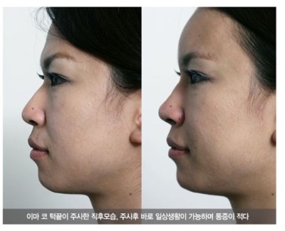 [알아두세요] 쁘띠성형 관련 이미지 3