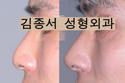 컴플렉스 매부리코 코성형으로 예쁜 코를 만들어보자! 관련 이미지 1
