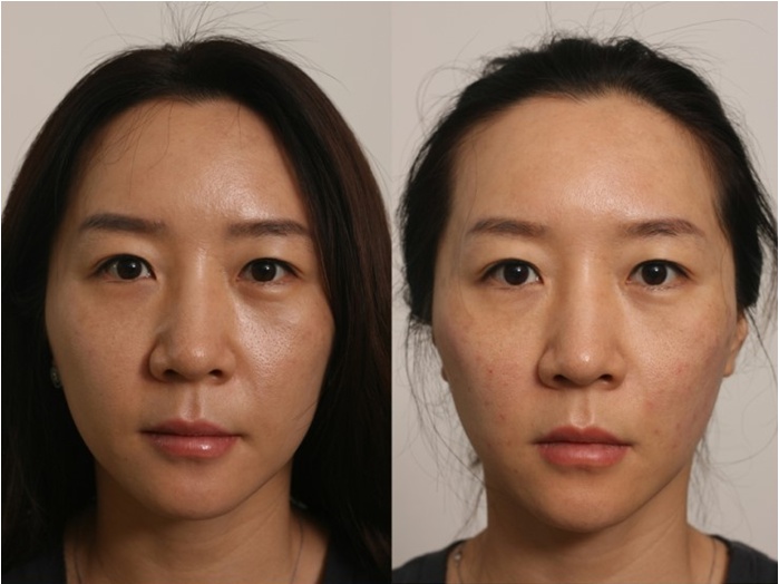 주름없이 팽팽한 얼굴만들기 실리프팅! 관련 이미지 5