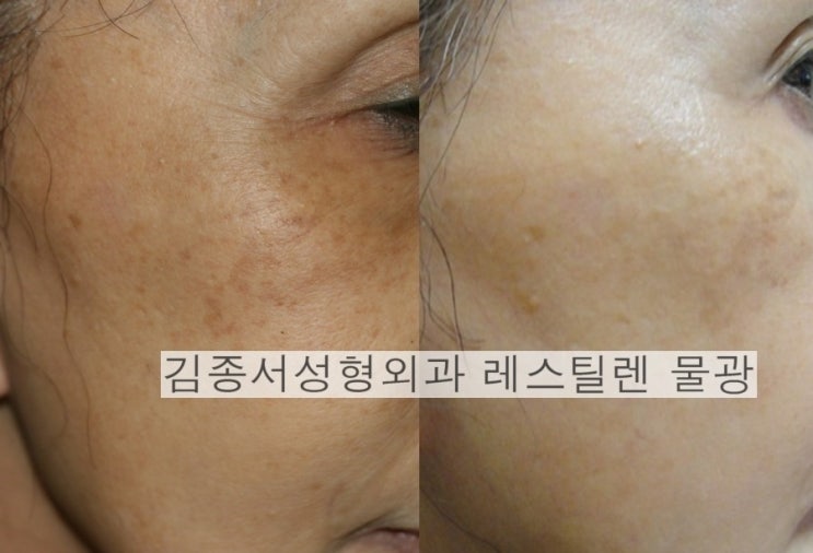 홍콩 세미나/ 레스틸렌 물광 / 김종서성형외과원장 2014-6-10-화 관련 이미지 4