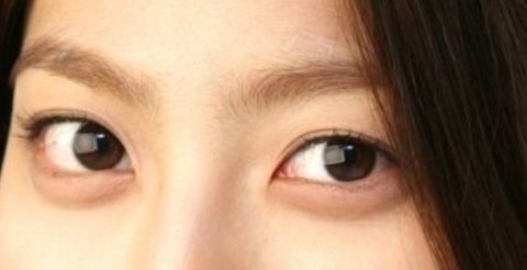 Lower Blepharoplasty at a Gangnam Plastic Surgery Clinic image 3