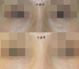 다크써클의 원인이 되는 눈밑지방, 눈밑지방제거수술 관련 이미지 3