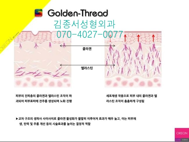 금실PDO매선 한국에서 세계최초 출시 / 김종서성형외과 금실-시술병원 선정 관련 이미지 6