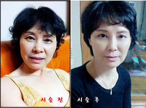 안면리프팅 관련 이미지 7