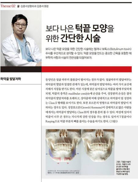 턱끝을 위한 시술방법 / 메디칼S잡지에 실렸습니다 / 김종서성형외과 관련 이미지 1