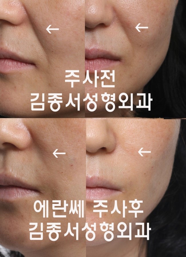엘란쎄 강의/2013 대한미용성형외과 학회/ 코엑스 2013.4.27일 관련 이미지 3
