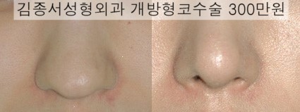 개방형코수술 / 미스코의 차이를 느껴보세요 / 김종서원장블로그 관련 이미지 1