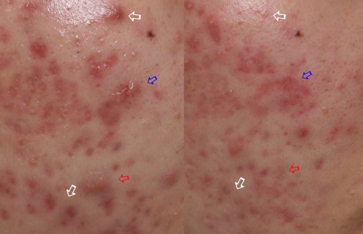 Acne Care / Acne Scar / Pore Care MTS (Retinage Goldstem) Before-and-After Photos After One Treatment image 1