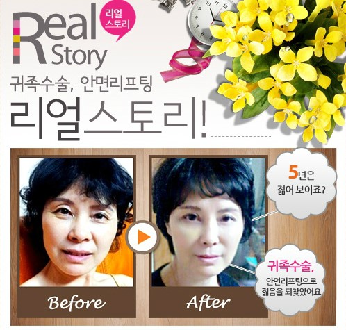안면리프팅 수술없이 할수 있을까? 관련 이미지 6