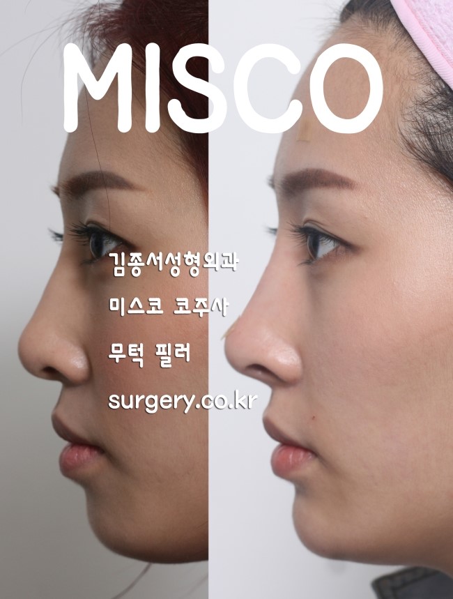 미스코 코필러 / 김종서성형외과 / 간단하게 코를 오똑하게 코수술을 하지 않고도 예쁜코를? 관련 이미지 2