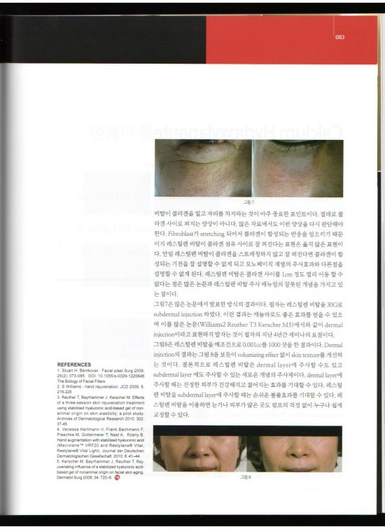 메디컬S 김종서성형외과 인터뷰/레스틸렌 비탈 엄지원필러/주름개선 물광주사 관련 이미지 5